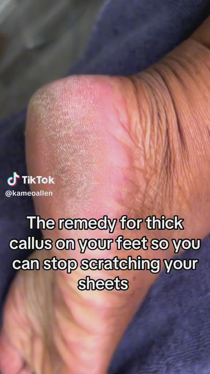 Smooth Steps Feet Callus Remover | 30 FREE Sandpaper disks included